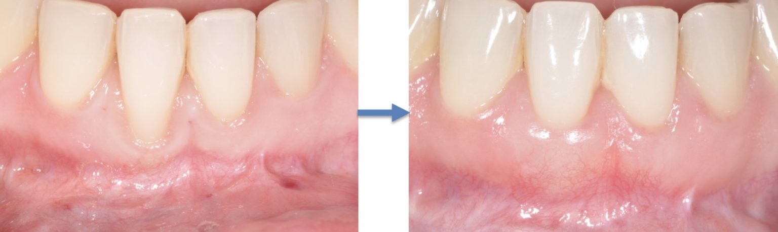 Greffe de gencive et procédure gingivale esthétique Spécialistes